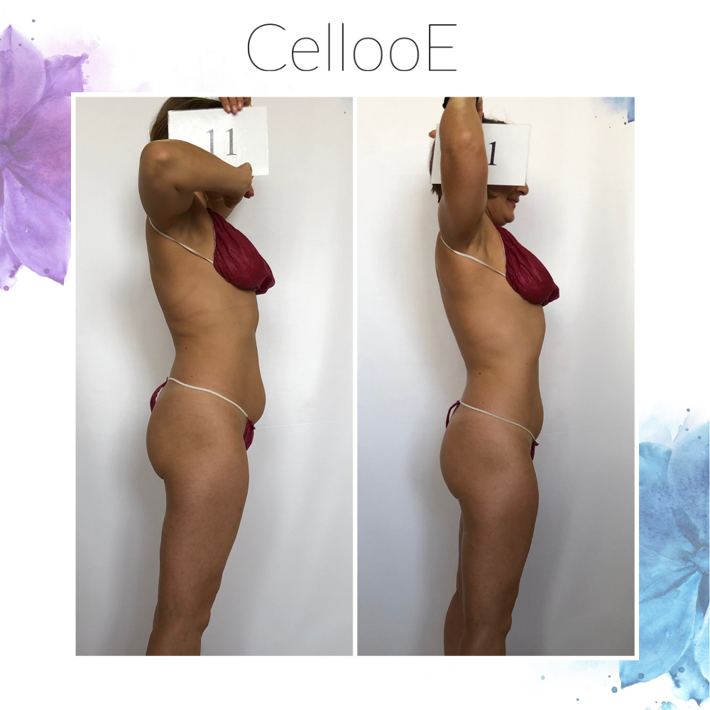 Профессиональная косметика CellooE для коррекции фигуры